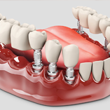پروتز دندان در مطب دکتر وحید سلطان کریمی
