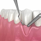 جراحی یا ترمیم لثه چیست؟
