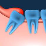 بررسی دکتر سلطان کریمی علل، علائم و درمان نهفتگی دندان